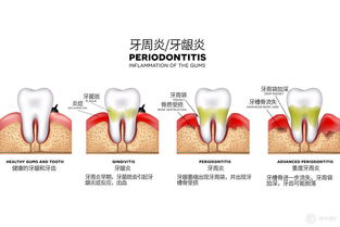 牙周炎治疗的过程及其风险,大家需要认真了解下！