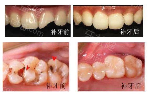 挑戰傳統觀念做補牙齒的過程揭秘是否真的存在風險一文讀懂