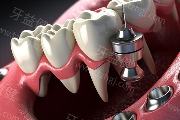 福州种植牙价格表!2025收费价格大揭秘这5家性价比高